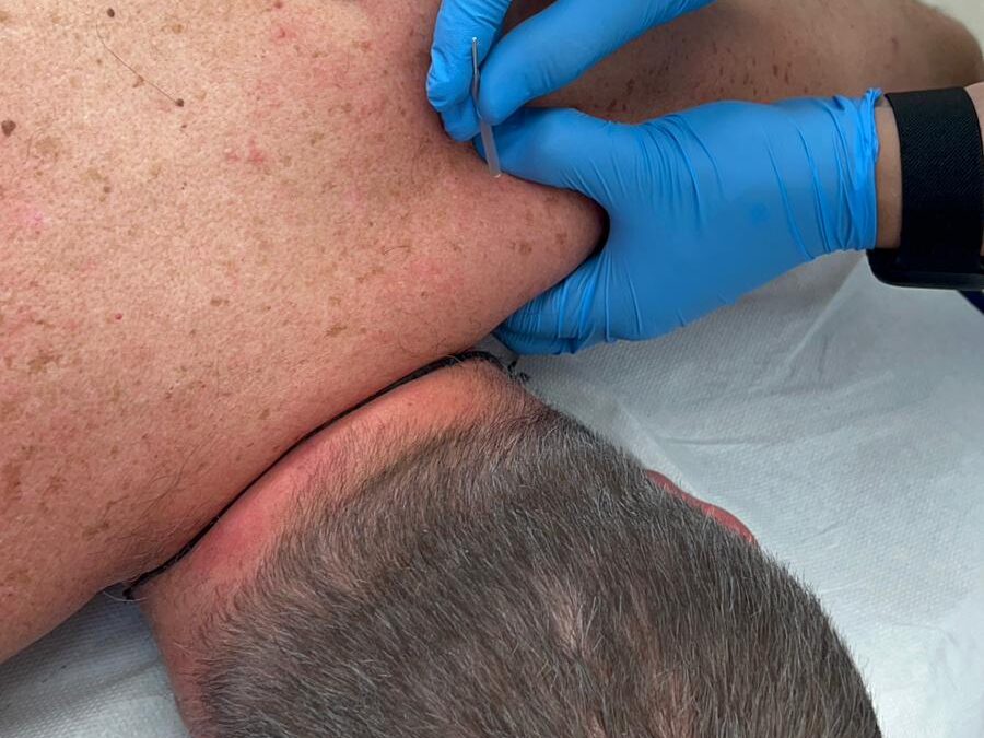 ¿Qué es la punción seca?